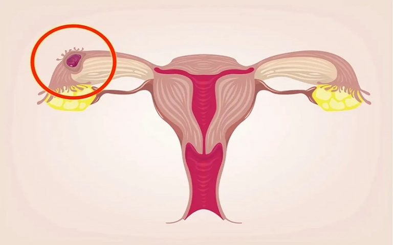 Vì sao siêu âm có túi thai nhưng chưa thấy phôi thai